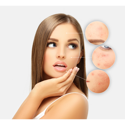 3 Acne Skin Care Tips For A Healthier Skin