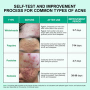 Acne Removal Treatment